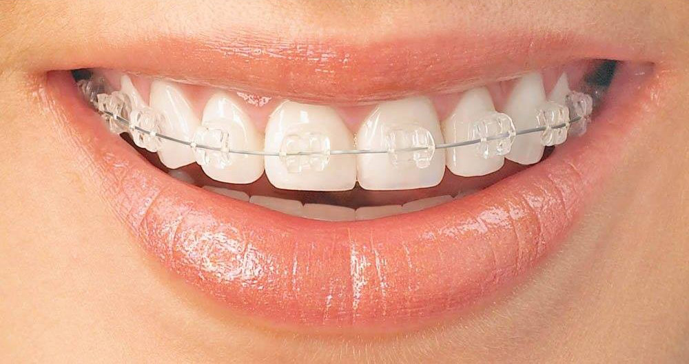 ارتودنسی دندان