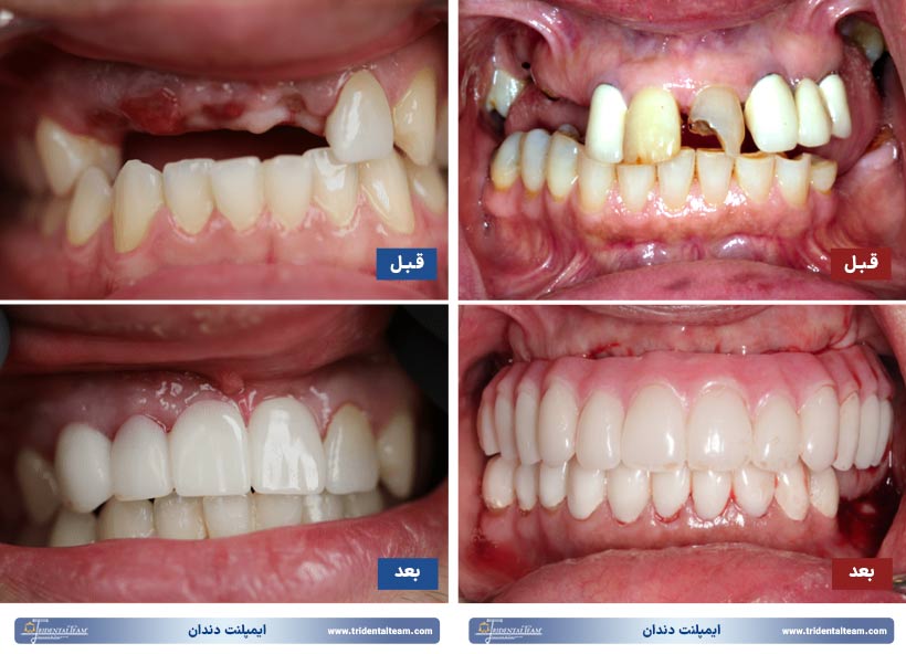 ایمپلنت دندان قبل و بعد