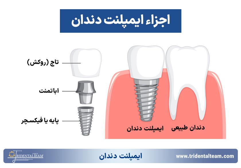 اجزاء ایمپلنت دندان