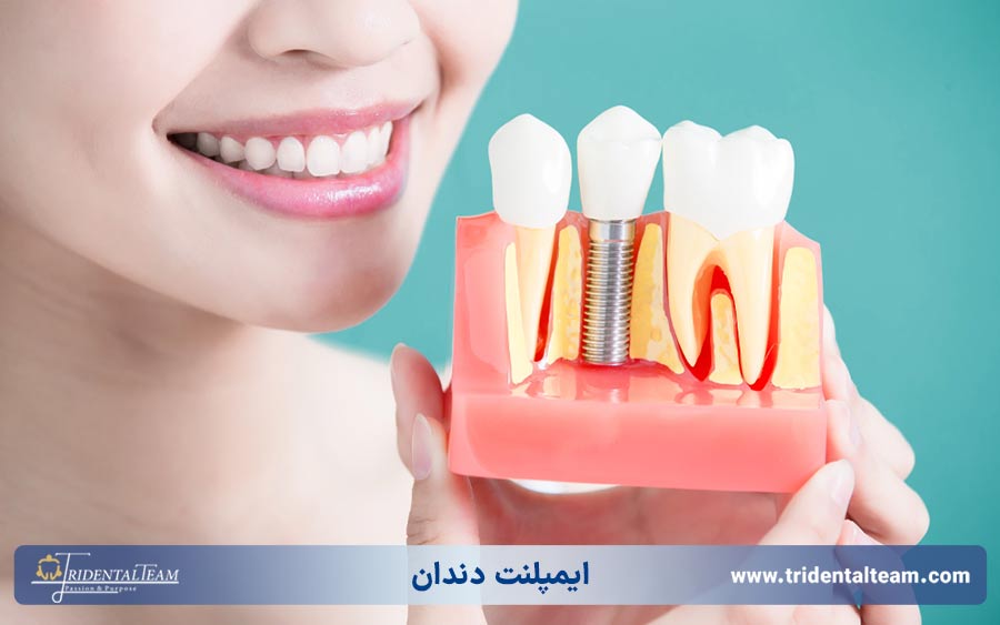 ایمپلنت دندان در تهران