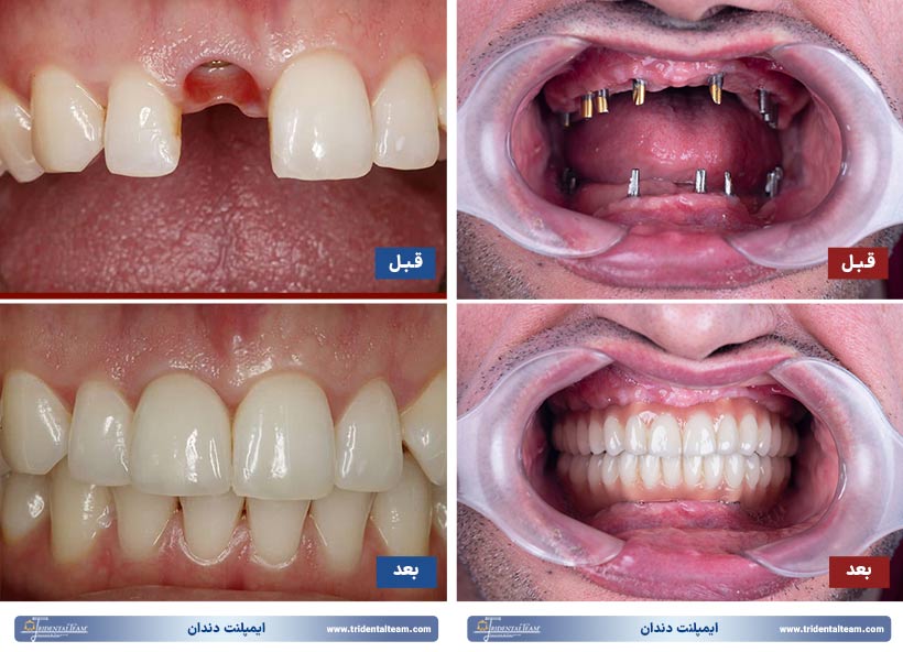 تصاویر ایمپلنت دندان قبل و بعد
