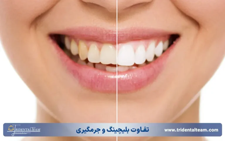 تفاوت بلیچینگ و جرمگیری دندان