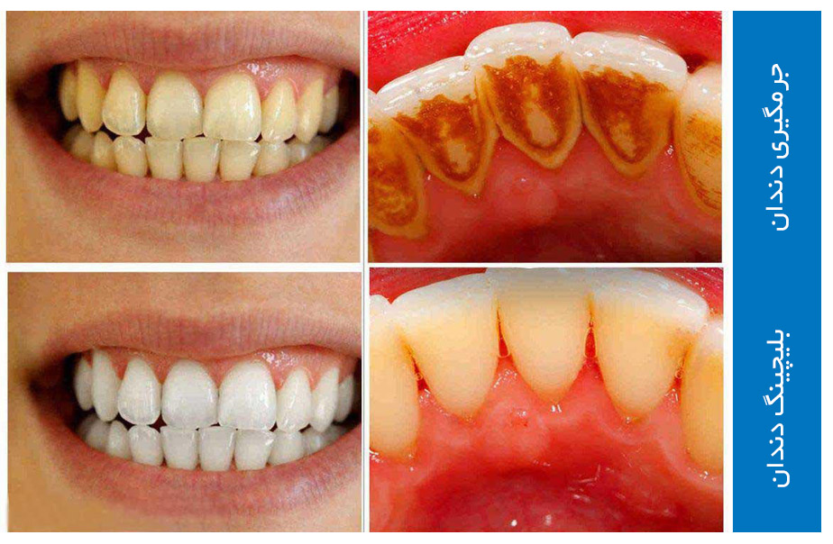 تفاوت بلیچینگ و جرمگیری دندان