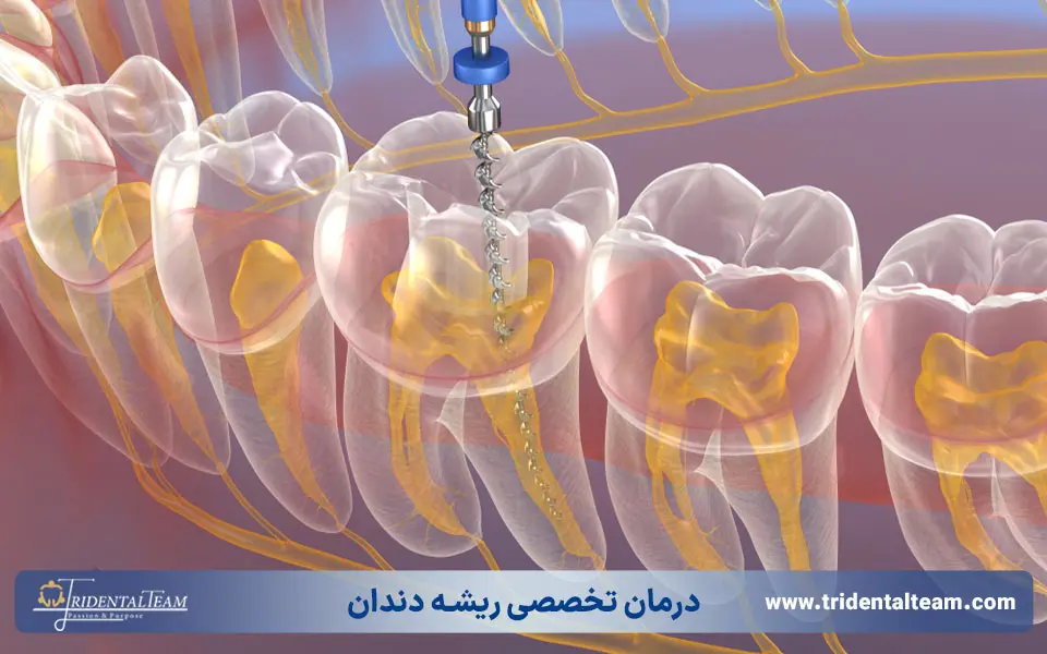 درمان تخصصی ریشه دندان
