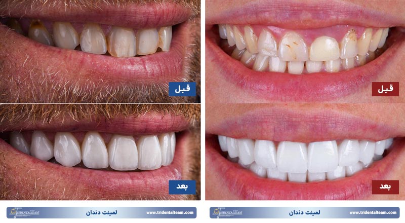 لمینت دندان