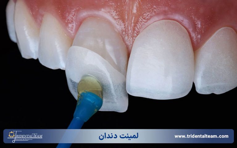 لمینت دندان چیست