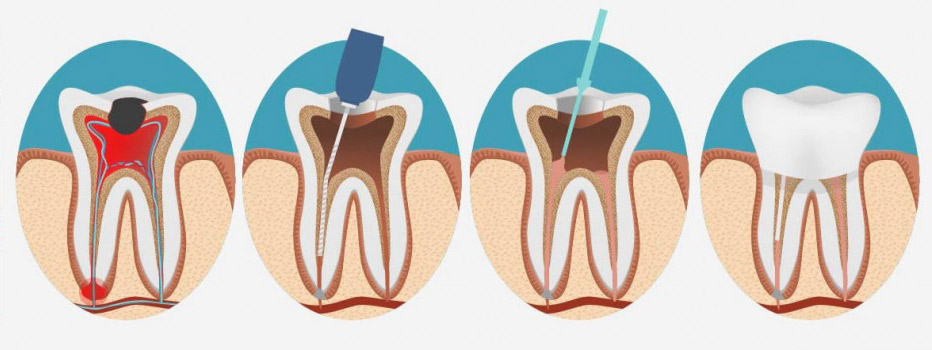 درمان ریشه دندان