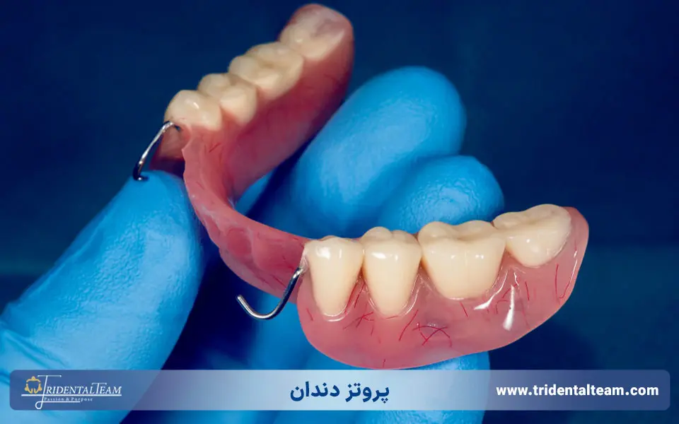 پروتز دندان