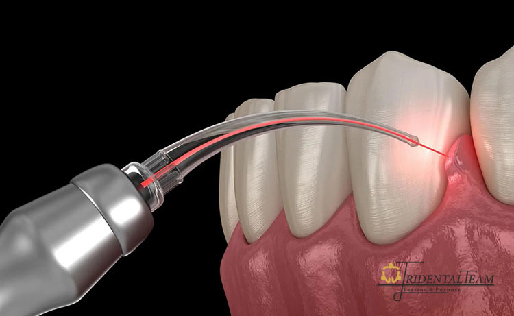 انواع جراحی لثه