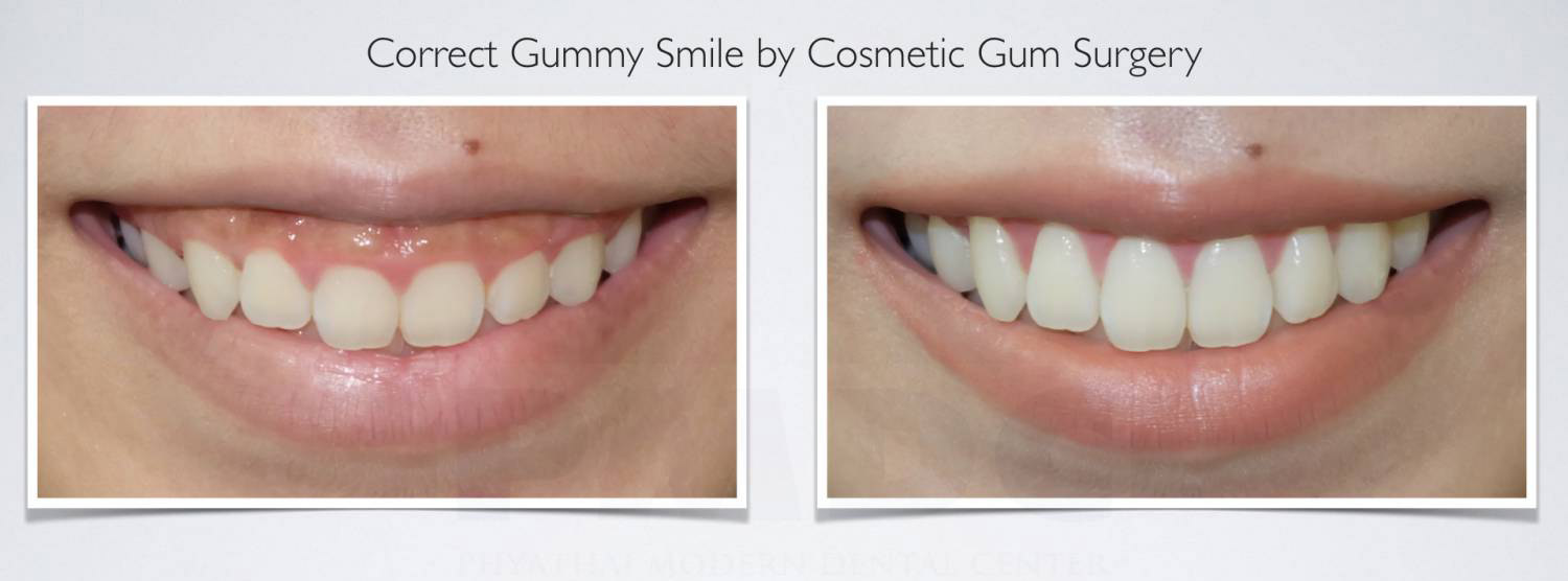 جراحی لیفت لثه