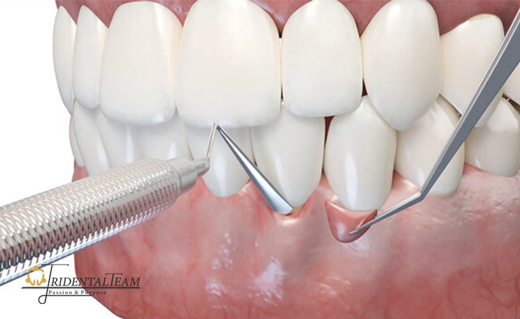 جراحی لثه چیست