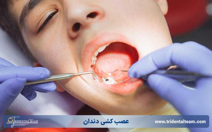 عصب کشی دندان