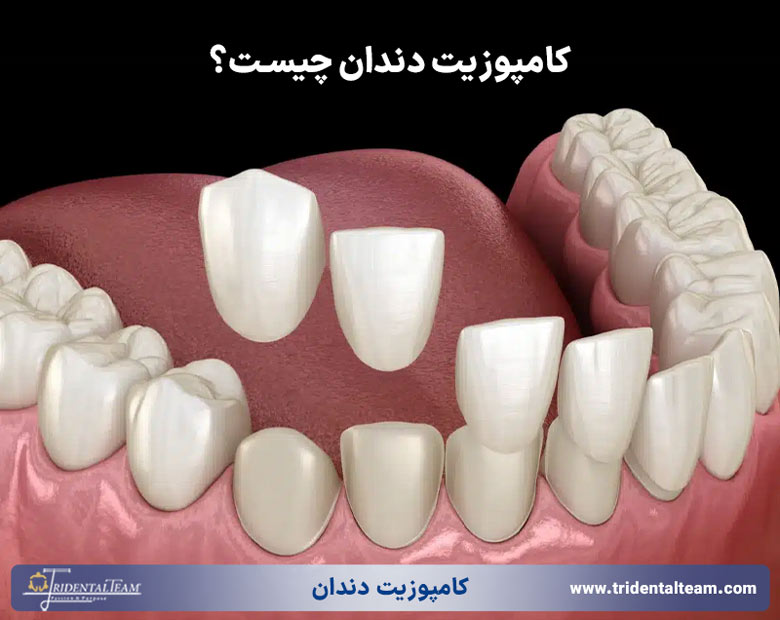 کامپوزیت دندان چیست؟