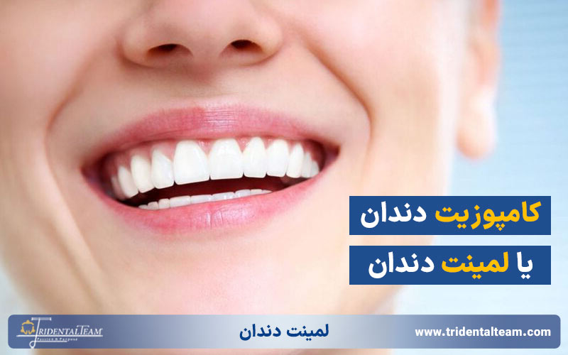 تفاوت کامپوزیت دندان با لمینت دندان