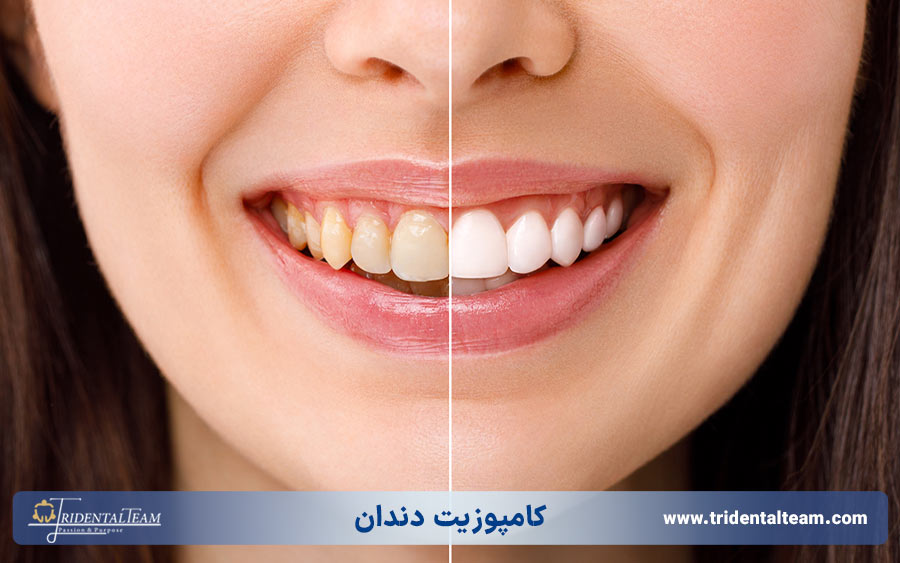 کامپوزیت دندان