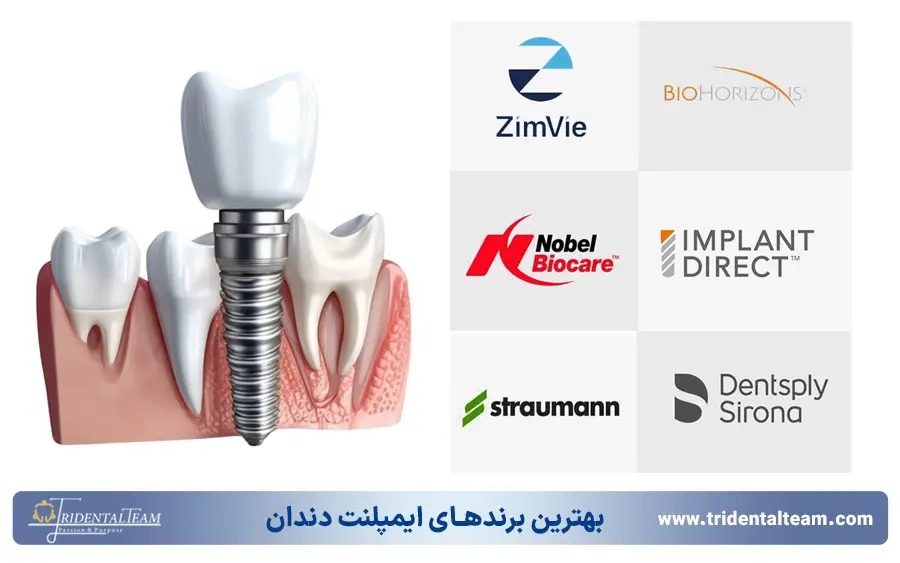 بهترین برندهای ایمپلنت دندان