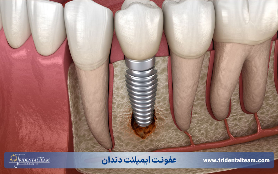 عفونت ایمپلنت دندان