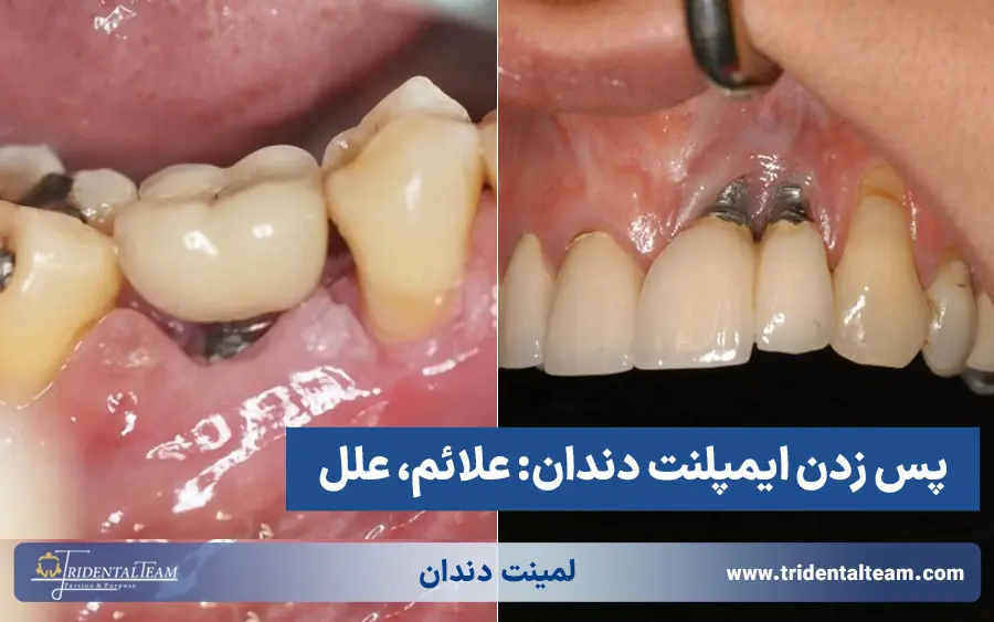 پس زدن ایمپلنت دندان
