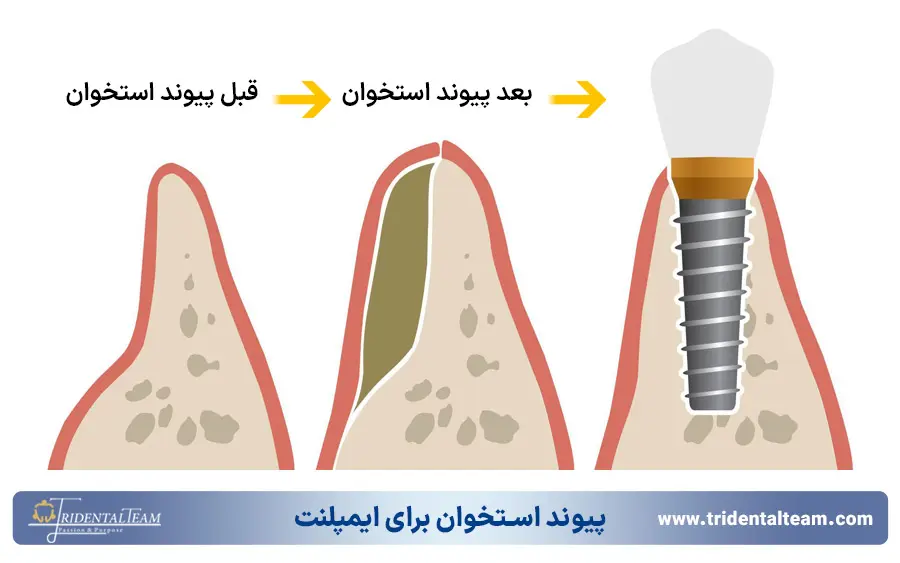 پیوند استخوان برای ایمپلنت دندان