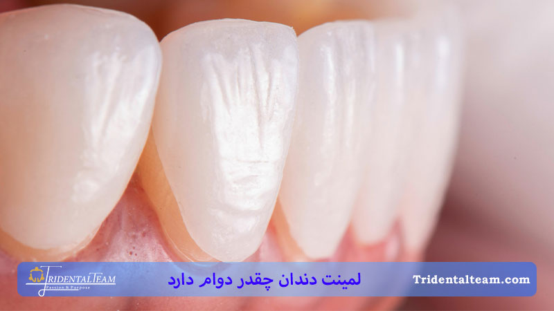 نمای نزدیک از دندان لمینت شده