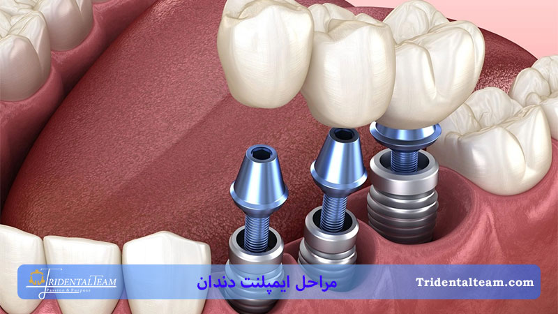 ایمپلنت دندان های مختلف ذهان