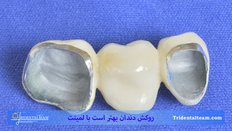 روکش دندان بهتر است یا لمینت