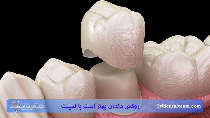 روکش کردن دندان
