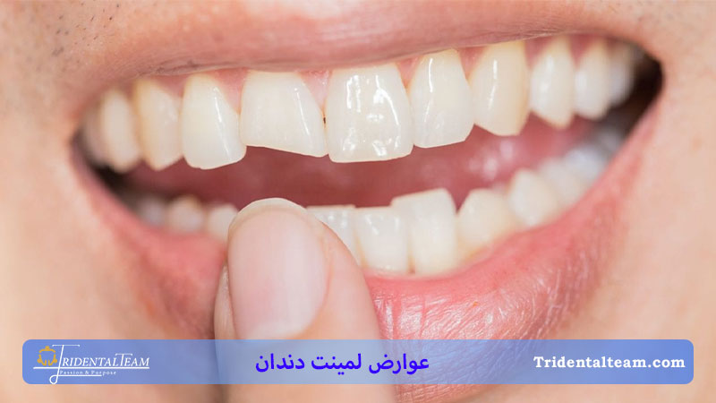 شکستن لمینت دندان