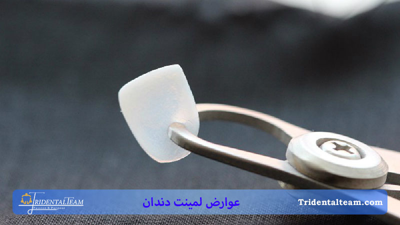 عوارض لمینت دندان