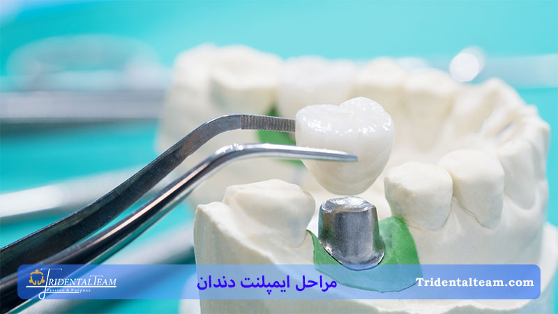 مراقبت های بعد از ایمپلنت دندان