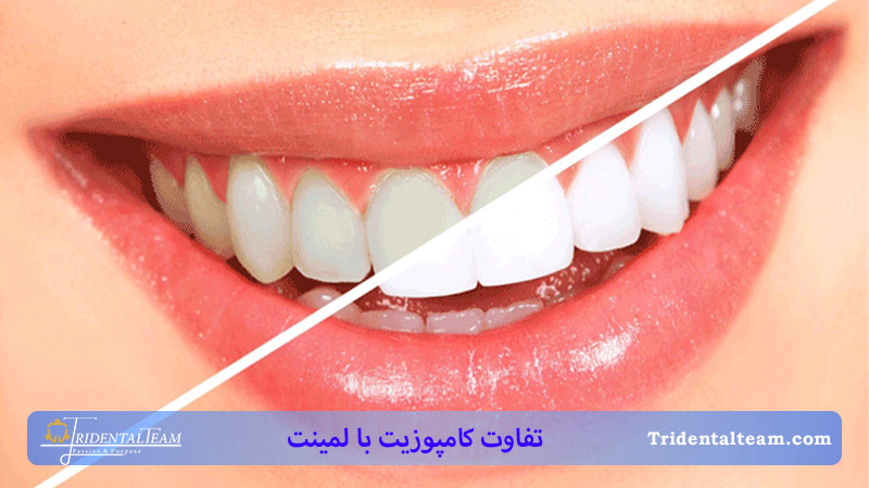 کامپوزیت بهتر است یا لمینت