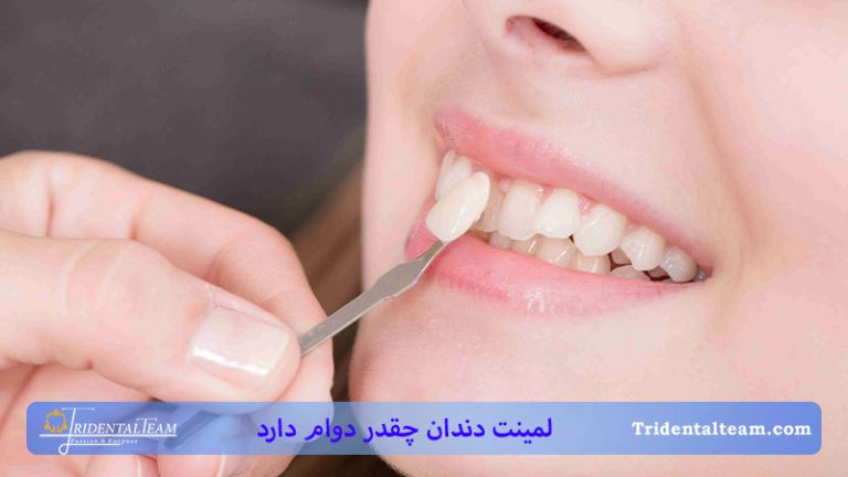 لمینت دندان چقدر دوام دارد