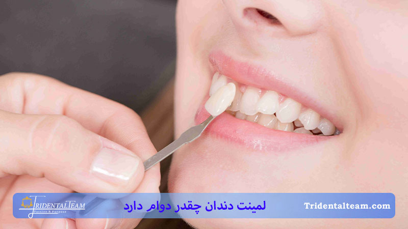 لمینت دندان چقدر دوام دارد