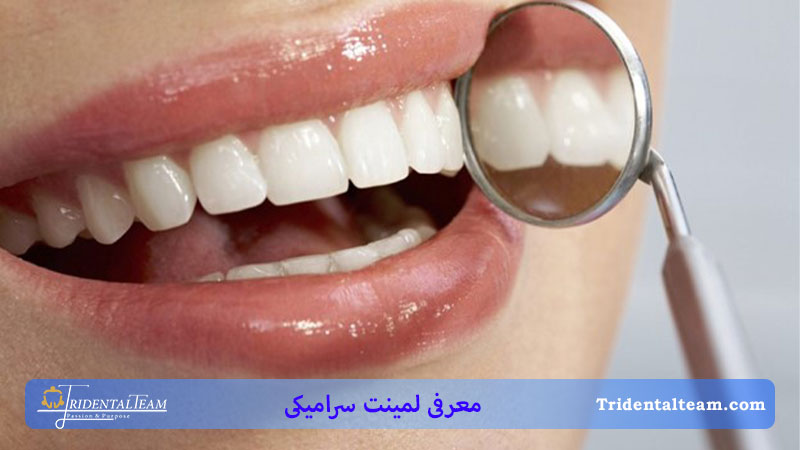 لمینت سرامیکی برای چه کسانی مناسب است