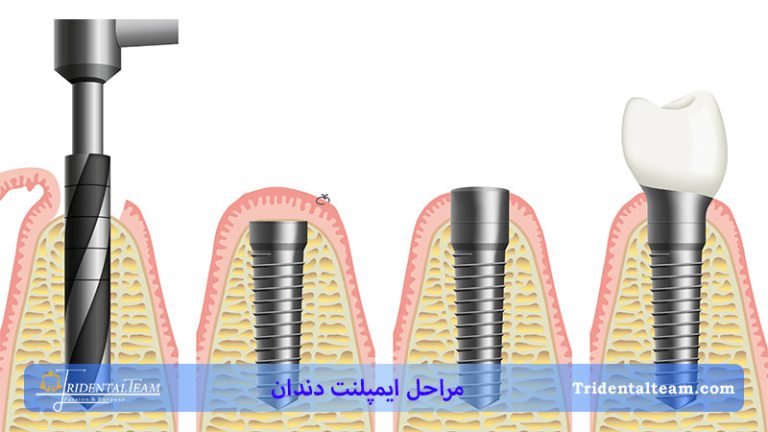 مراحل ایمپلنت دندان