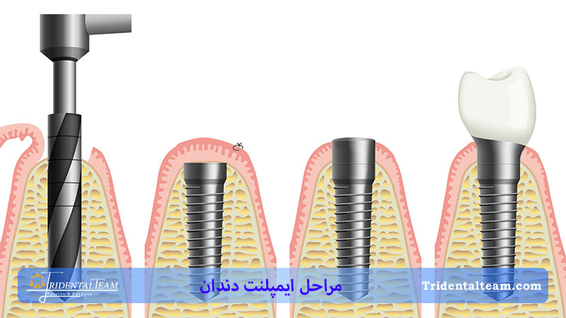 مراحل ایمپلنت دندان