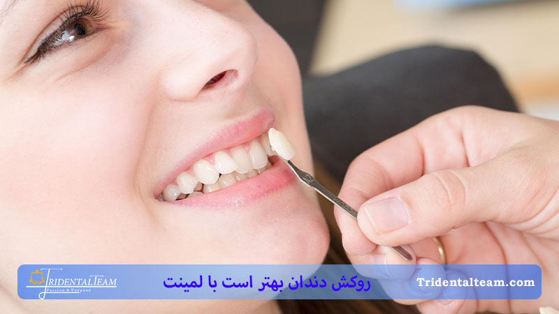 لمینت دندان روکش شده