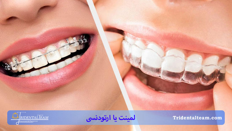 مقایسه لمینت و ارتودنسی دندان
