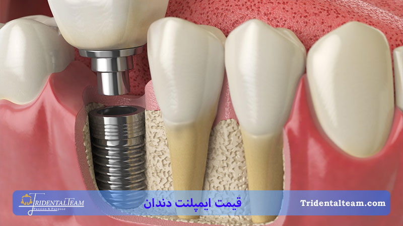 ایمپلنت دندان در فک