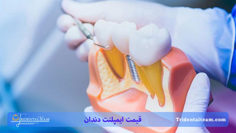 قیمت ایمپلنت دندان