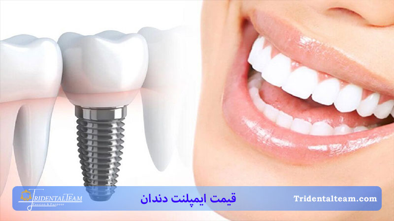 قیمت ایمپلنت دندان در ایران