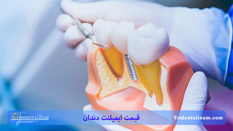 قیمت ایمپلنت دندان