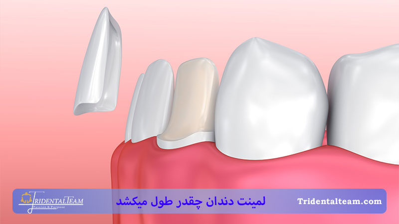 مراقبت های بعد از لمینت 