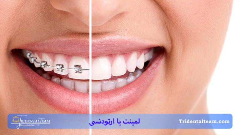 لمینت یا ارتودنسی دندان