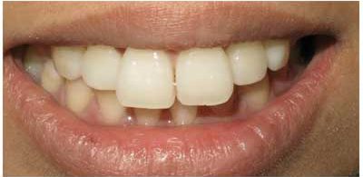 دندان خرگوشی چیست