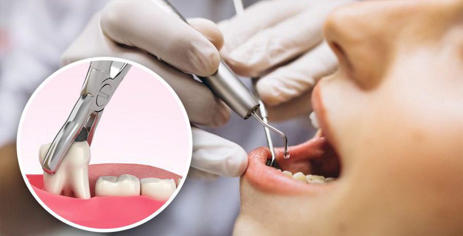 کشیدن دندان عقل