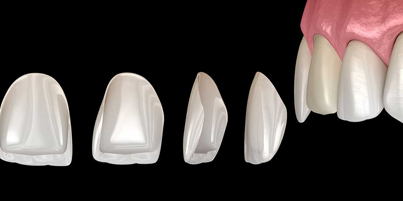 لمینت شیشه ای دندان