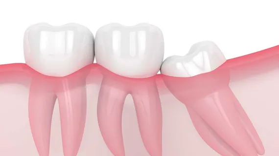 علائم نیاز به جراحی دندان عقل