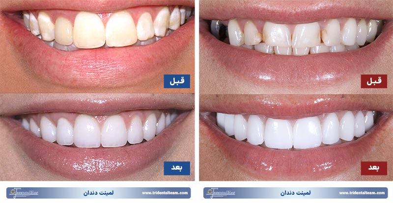 قبل و بعد لمینت دندان