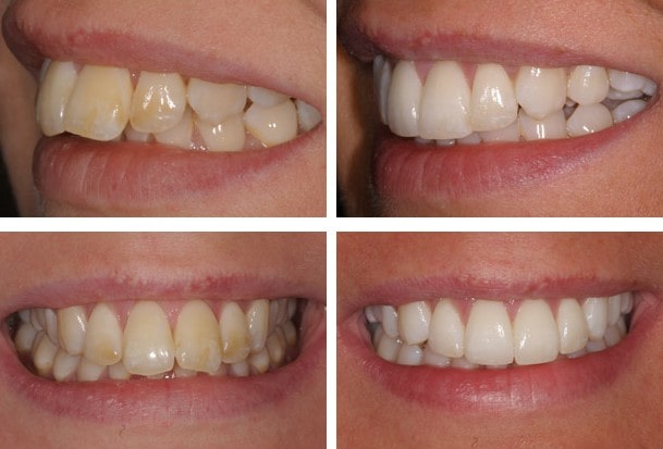 کامپوزیت دندان خرگوشی چیست؟